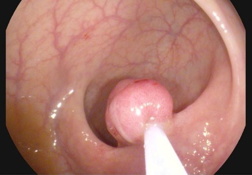 內視鏡下的大腸瘜肉 Image