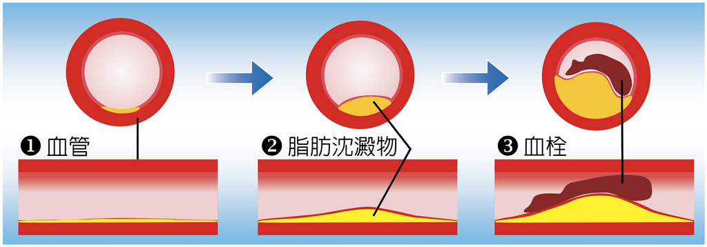 冠狀動脈粥狀血管硬化過程，1.正常動脈 2.形成動脈硬化血塊 3.被血塊阻塞的動脈
