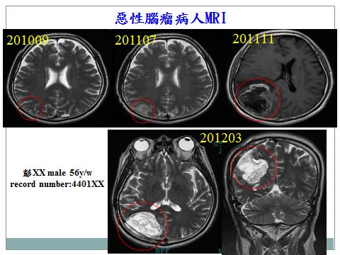 惡性腦瘤擴散