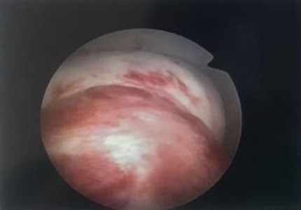 診斷性子宮腔鏡門診　早期發現深層子宮肌瘤早期治療