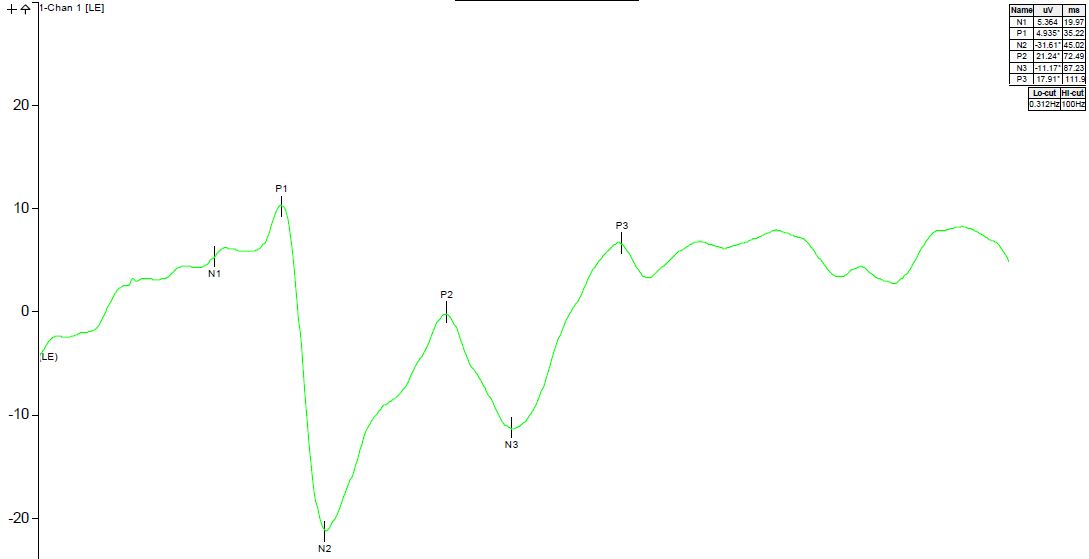 Visual evoked potential plot Visual evoked potential plot