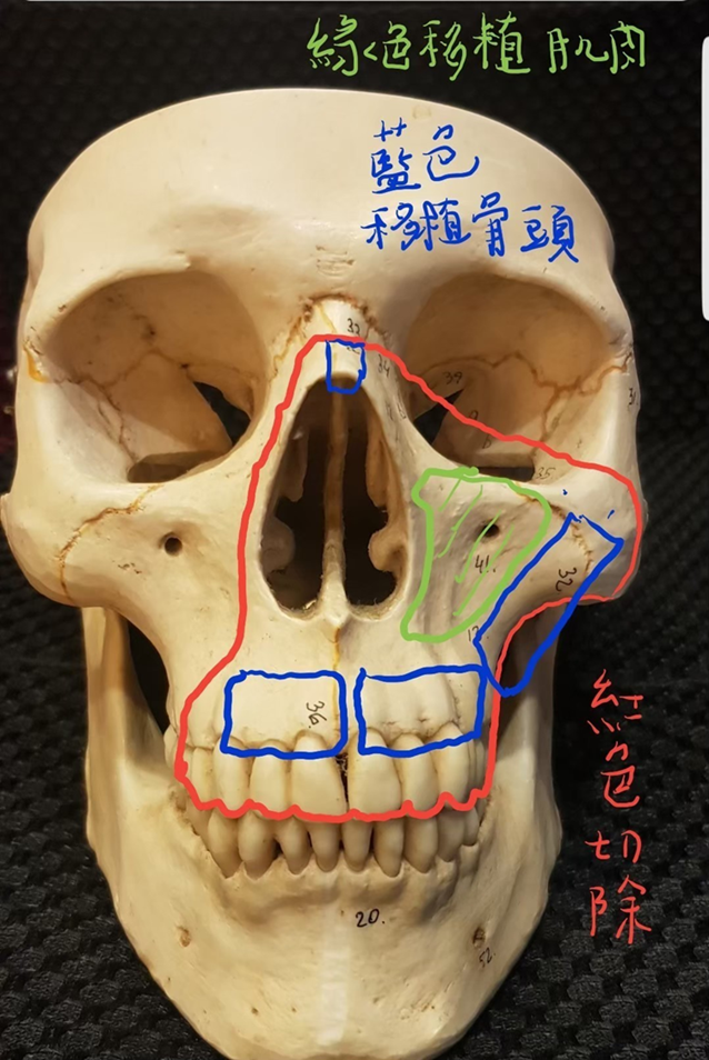 大破壞後的重建，要維持麥可左眼、鼻部呼吸、口腔功能和外觀，整形暨重建外科團隊為麥可進行眼眶顴骨複合區結構重建